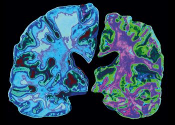 Scientific Evidence is now Available on How to Prevent Dementia