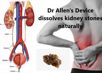 Dr Allen’s Device Cleans Kidneys from Stones Naturally