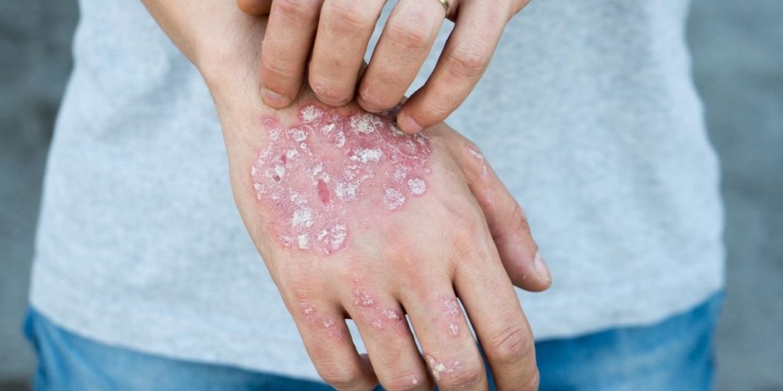 4 Top Tips for Managing Psoriasis