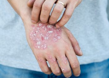 4 Top Tips for Managing Psoriasis