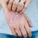 4 Top Tips for Managing Psoriasis