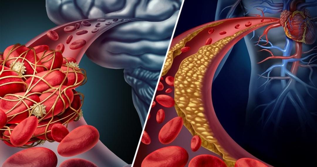 The Difference Between a Stroke and a Heart Attack