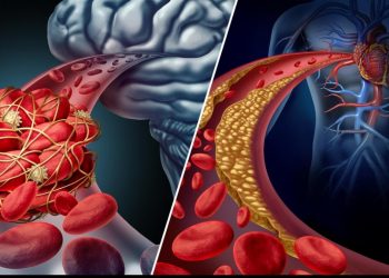The Difference Between a Stroke and a Heart Attack
