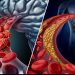 The Difference Between a Stroke and a Heart Attack